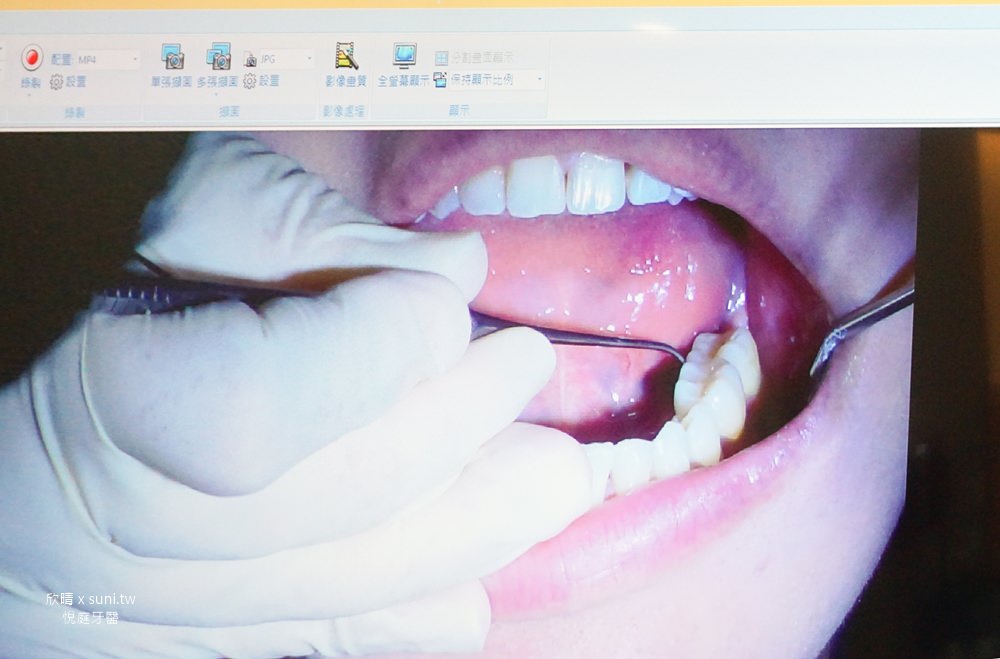 台北牙醫診所推薦悅庭一日全瓷冠/美白牙齒瓷牙貼片/植牙｜專屬微笑曲線不是夢~原來牙技師來是這樣做出牙齒